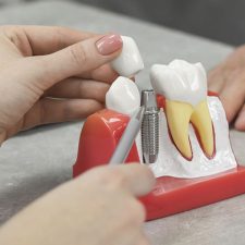 How to Make Your Dental Implants Last a Lifetime