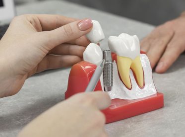 How to Make Your Dental Implants Last a Lifetime