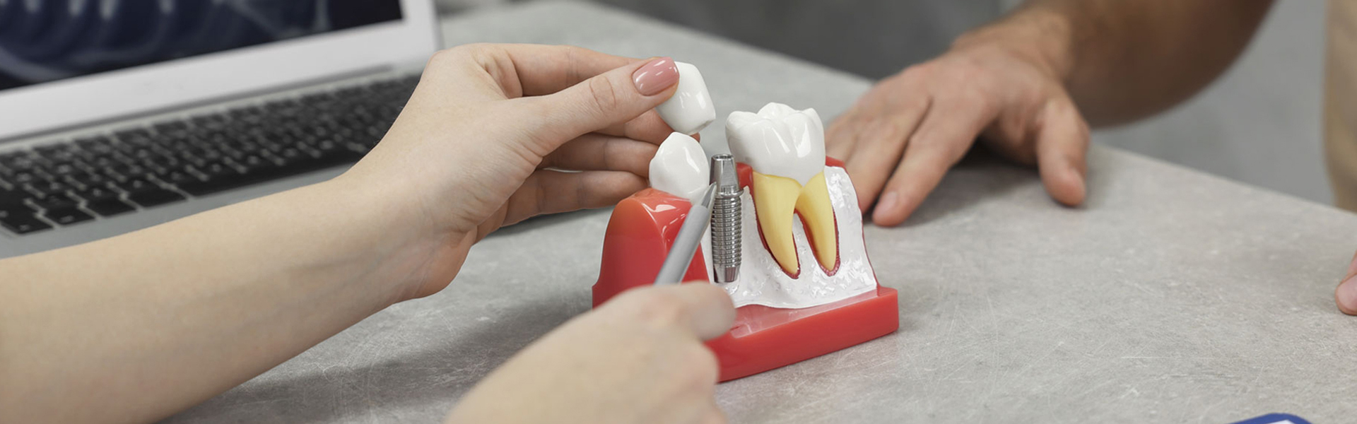 How to Make Your Dental Implants Last a Lifetime