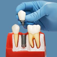 How to Care for Your Dental Implants for Long-Term Results