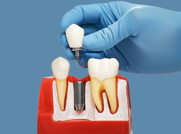 How to Care for Your Dental Implants for Long-Term Results