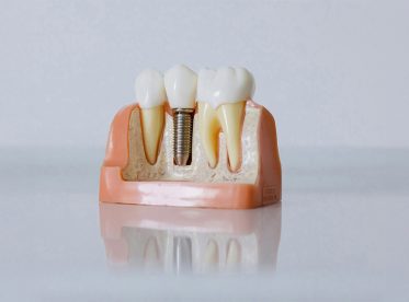 Why Dental Implants Are Considered the Gold Standard for Tooth Replacement